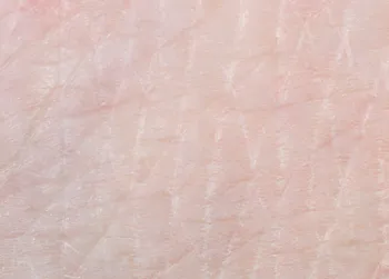 Wat te doen met strepen op de huid? Deze thuis-exfoliatie vermindert hun zichtbaarheid